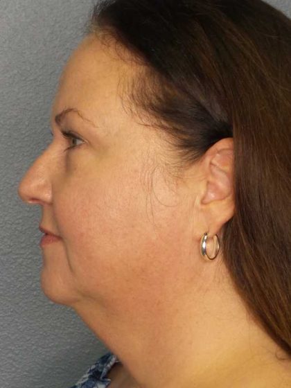 Liposuction of the Neck Before & After Patient #12104