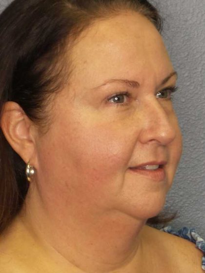 Liposuction of the Neck Before & After Patient #12104
