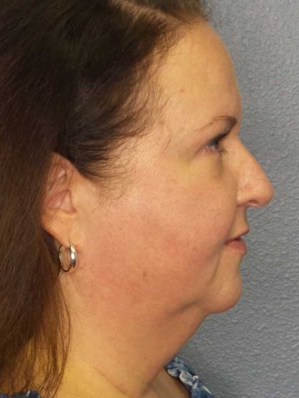 Liposuction of the Neck Before & After Patient #12104