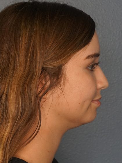 Liposuction of the Neck Before & After Patient #12071