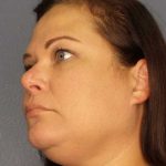 Liposuction of the Neck Before & After Patient #12181
