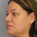 Liposuction of the Neck Before & After Patient #12159