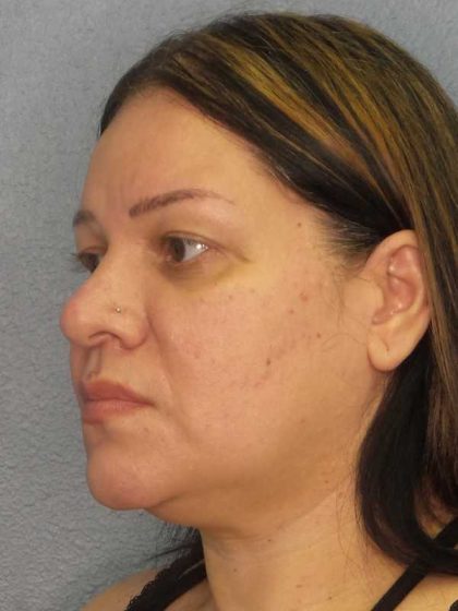 Liposuction of the Neck Before & After Patient #12159