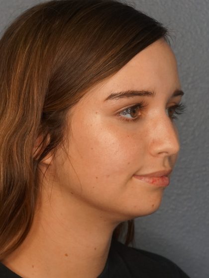 Liposuction of the Neck Before & After Patient #12071