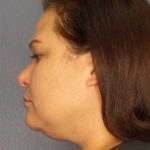 Liposuction of the Neck Before & After Patient #12181