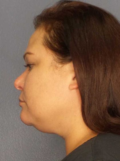 Liposuction of the Neck Before & After Patient #12181