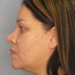 Liposuction of the Neck Before & After Patient #12159