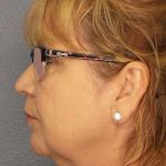 Liposuction of the Neck Before & After Patient #12192