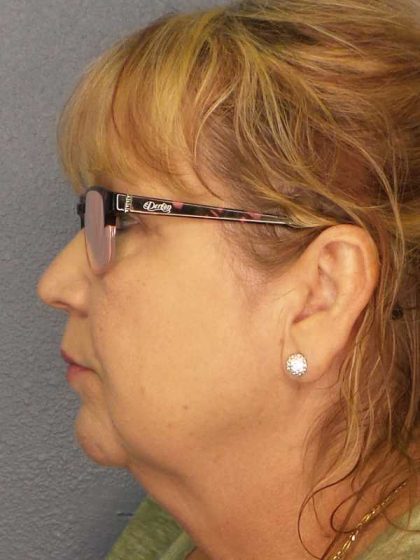 Liposuction of the Neck Before & After Patient #12192