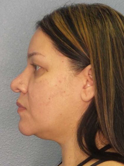 Liposuction of the Neck Before & After Patient #12159
