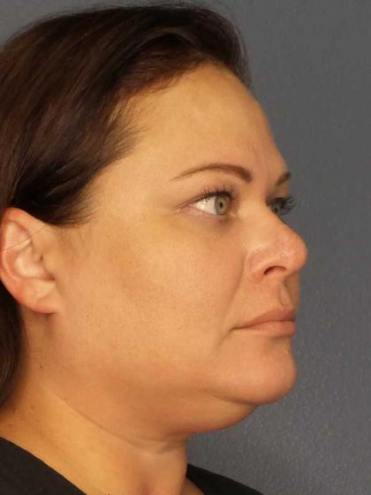 Liposuction of the Neck Before & After Patient #12181