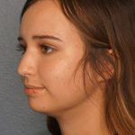 Liposuction of the Neck Before & After Patient #12071