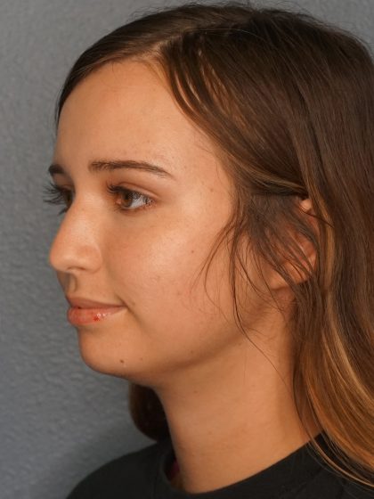 Liposuction of the Neck Before & After Patient #12071