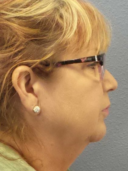 Liposuction of the Neck Before & After Patient #12192