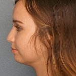 Liposuction of the Neck Before & After Patient #12071
