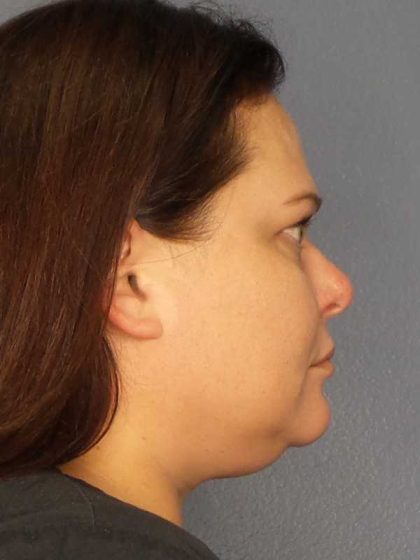 Liposuction of the Neck Before & After Patient #12181