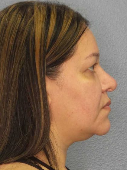 Liposuction of the Neck Before & After Patient #12159