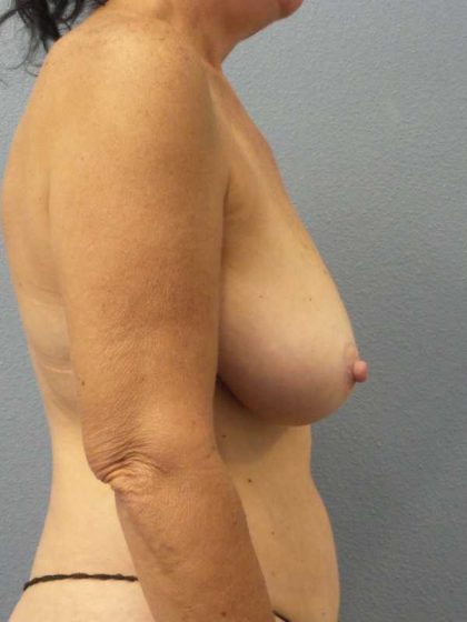 Mastopexy (Breast Lift) Before & After Patient #12281