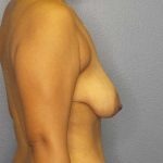 Mastopexy (Breast Lift) Before & After Patient #8351