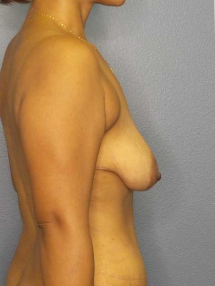 Mastopexy (Breast Lift) Before & After Patient #8351