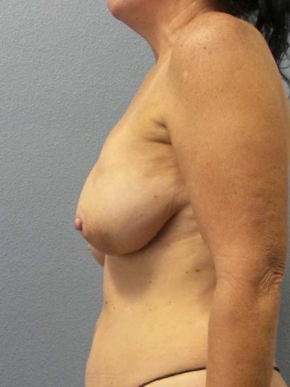 Mastopexy (Breast Lift) Before & After Patient #12281