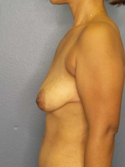 Mastopexy (Breast Lift) Before & After Patient #8351
