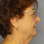 Liposuction of the Neck Before & After Patient #12137