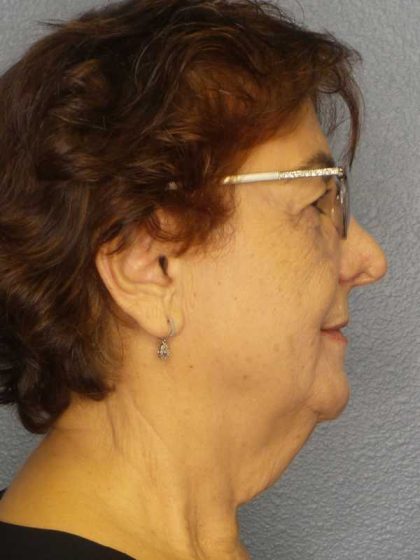Liposuction of the Neck Before & After Patient #12137