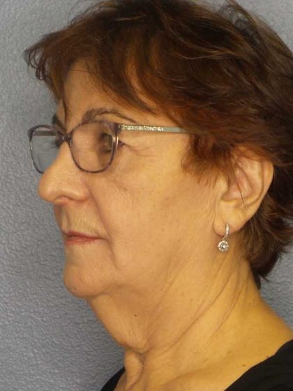 Liposuction of the Neck Before & After Patient #12137
