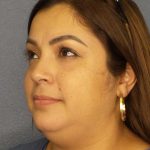 Liposuction of the Neck Before & After Patient #12126