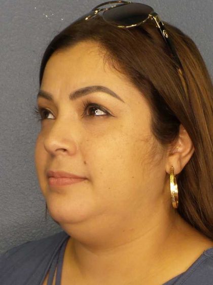 Liposuction of the Neck Before & After Patient #12126