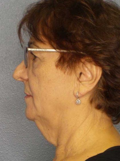 Liposuction of the Neck Before & After Patient #12137