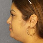 Liposuction of the Neck Before & After Patient #12126