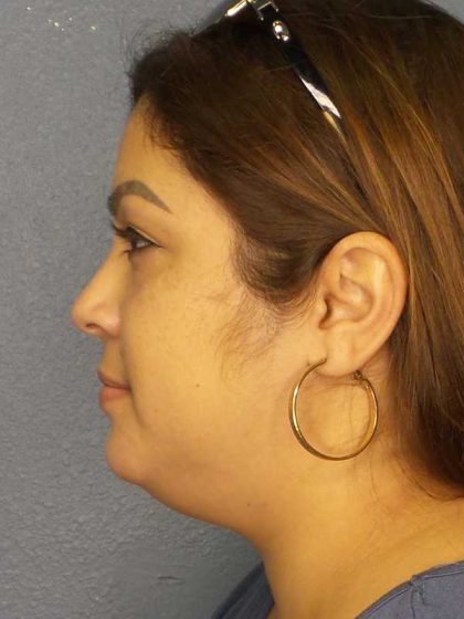 Liposuction of the Neck Before & After Patient #12126