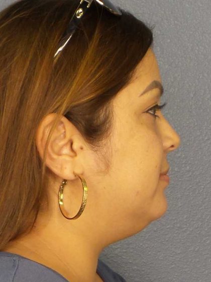 Liposuction of the Neck Before & After Patient #12126
