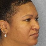 Rhinoplasty Before & After Patient #10805