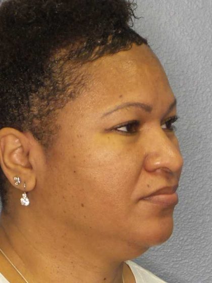 Rhinoplasty Before & After Patient #10805