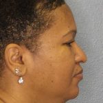 Rhinoplasty Before & After Patient #10805