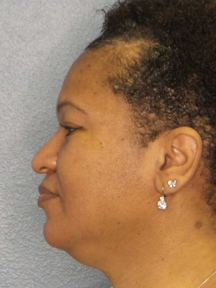 Rhinoplasty Before & After Patient #10805