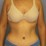 Abdominoplasty Before & After Patient #3322