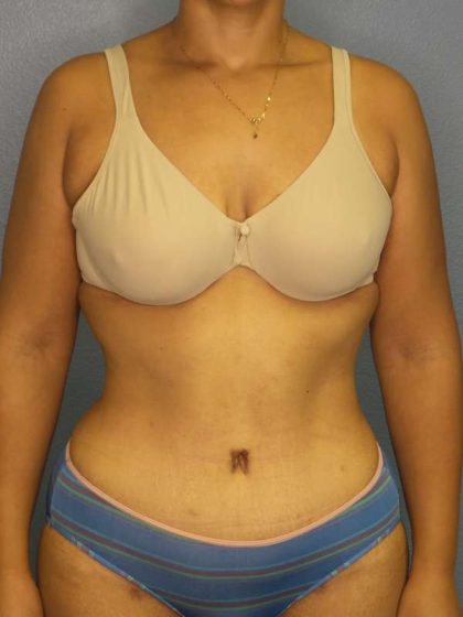 Abdominoplasty Before & After Patient #3322