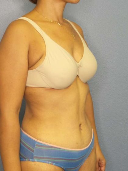 Abdominoplasty Before & After Patient #3322