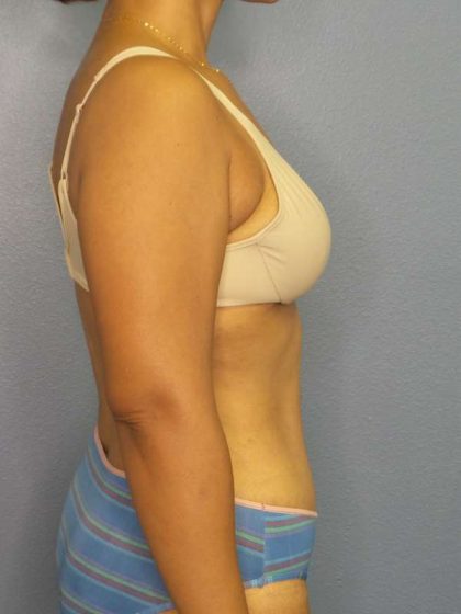 Abdominoplasty Before & After Patient #3322
