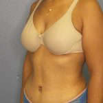 Abdominoplasty Before & After Patient #3322