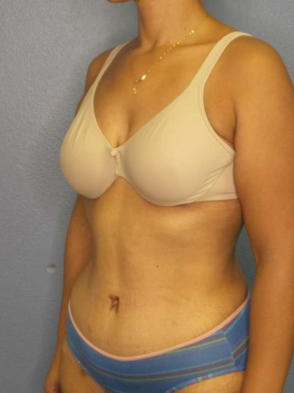 Abdominoplasty Before & After Patient #3322