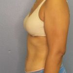 Abdominoplasty Before & After Patient #3322