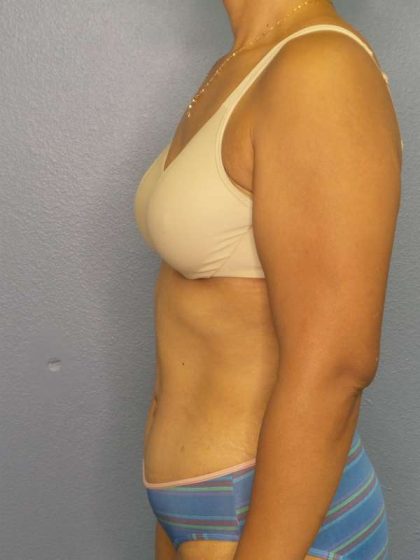 Abdominoplasty Before & After Patient #3322