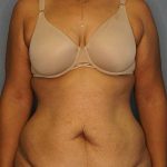 Abdominoplasty Before & After Patient #3322