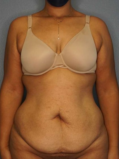 Abdominoplasty Before & After Patient #3322