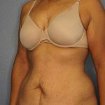 Abdominoplasty Before & After Patient #3322